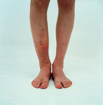 Brokenleg image