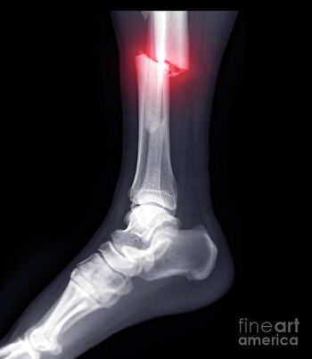 Brokenleg image
