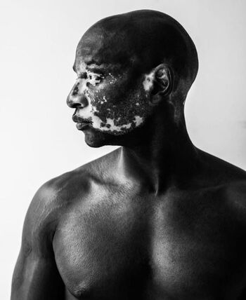 Vitiligo